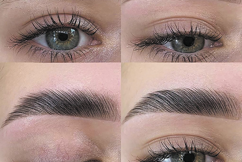 Browlift